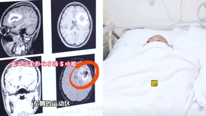 24-Year-Old Woman Mysteriously Stops Speaking Language She Was Fluent In